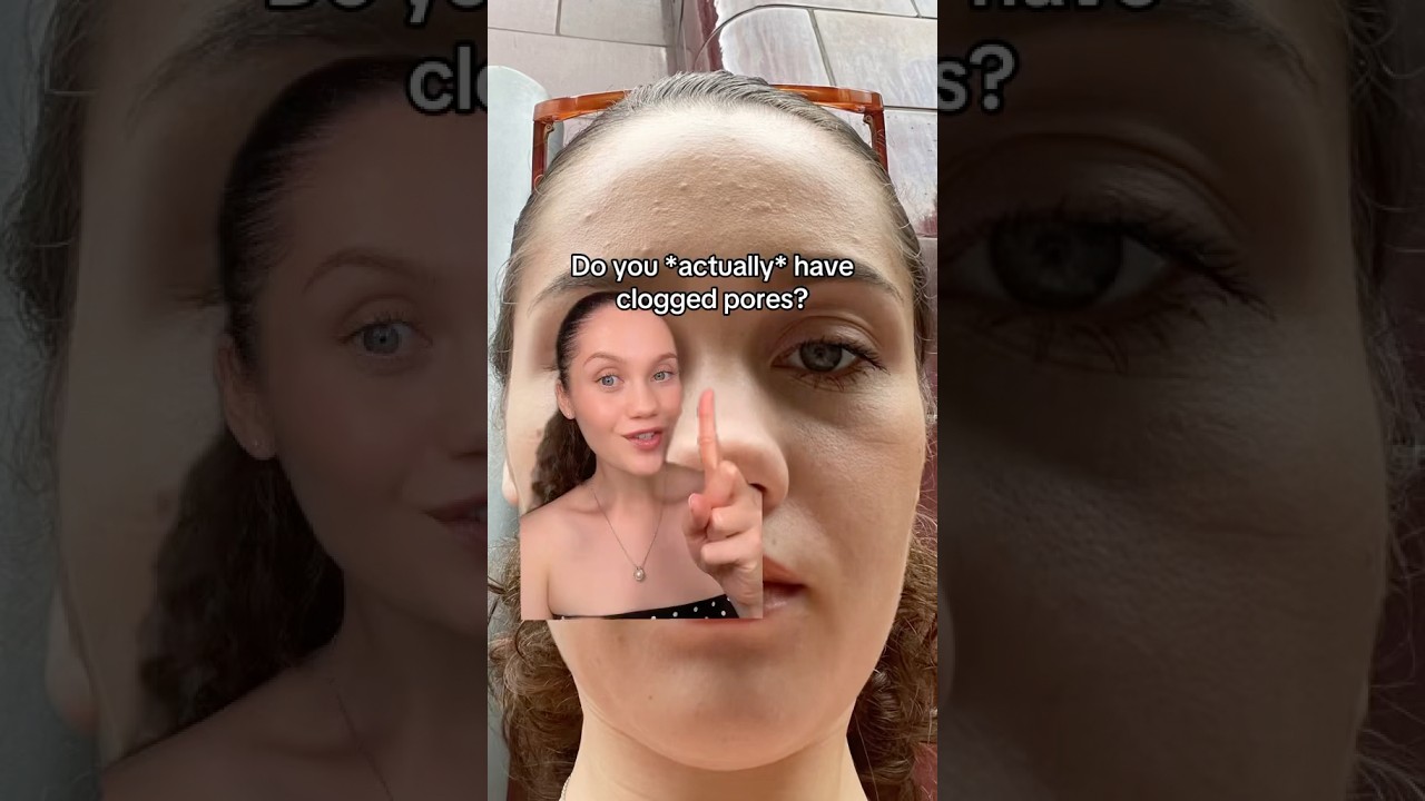 YOU ACTUALLY HAVE CLOGGED PORES⁉️