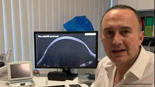 The Sub400 Protocol Cross-Linking Ultra-Thin Corneas