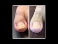 病院では完治しなかった爪。再発、膿、腫れとの闘いの末良くなった