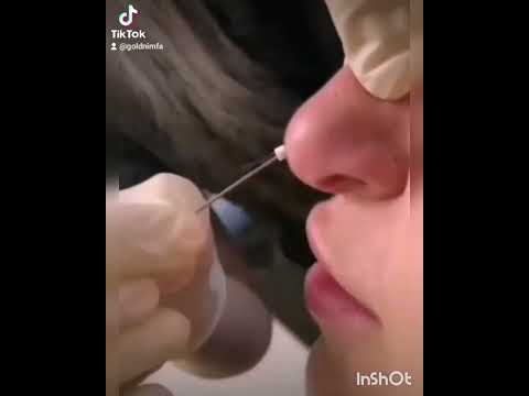 #nose #thread #filler #botox ცხვირის მოდელირება მეზოძაფებით nose modeling of mesothread