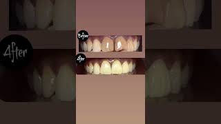 “We didn’t just change her teeth—we transformed her confidence.” ✨😁#viral #dentistry