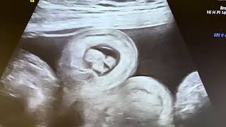 Extensive intussusception with invagination upto 1.5 feet n severe gut wall oedema n ascites. 30/F