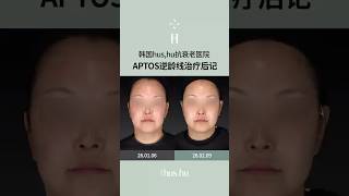 APTOS逆龄线治疗后记
