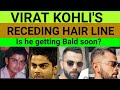 Case study : Virat Kohli's receding Hair Line | Reason of Baldness | Hair Transplant -The Street Guy