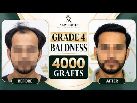 Natural-Looking Hair After 2 Years 😍 | Hair Transplant in Kolhapur | Cost and Best Results