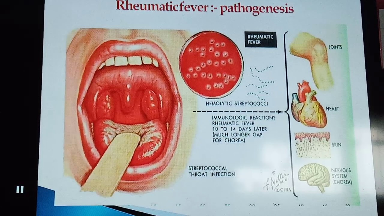 Rheumatic Heart Disease - YouTube