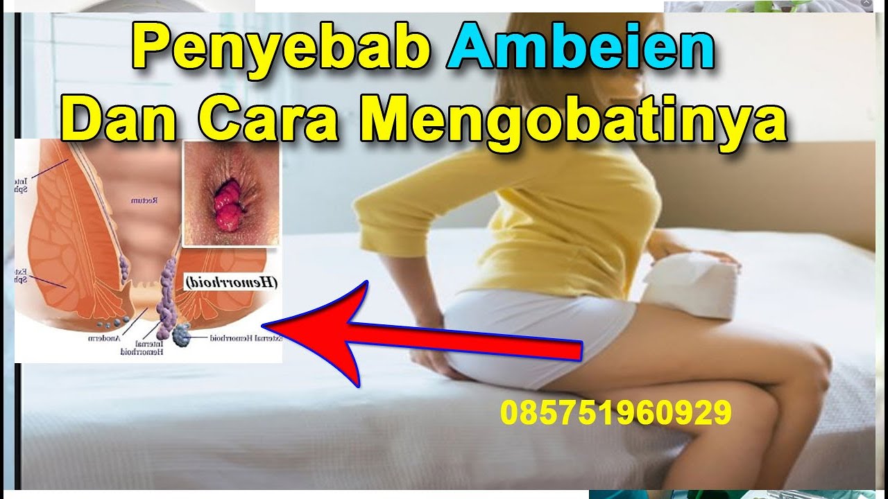 Penyebab Penyakit Ambeien Dan Cara Mengobatinya