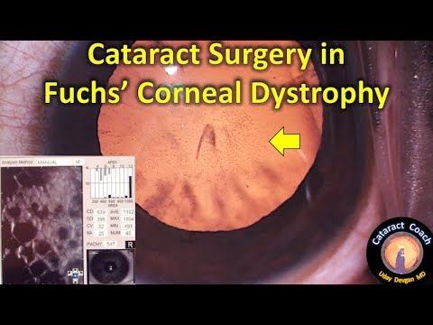 Cataract Surgery in Fuchs&rsquo; Corneal Dystrophy Patients