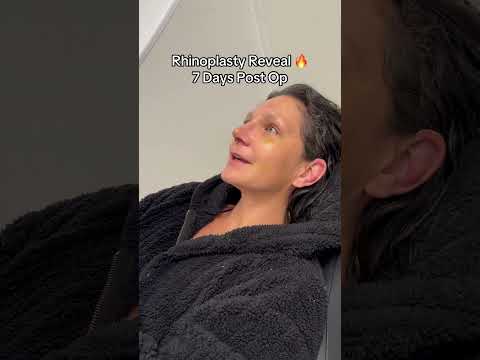 Video thumbnail: Rhinoplasty Reveal (7 Days Post Op) #nosejobbeforeandafter #rhinoplasty #ultrasonicrhinoplasty · Dr. Manish H. Shah