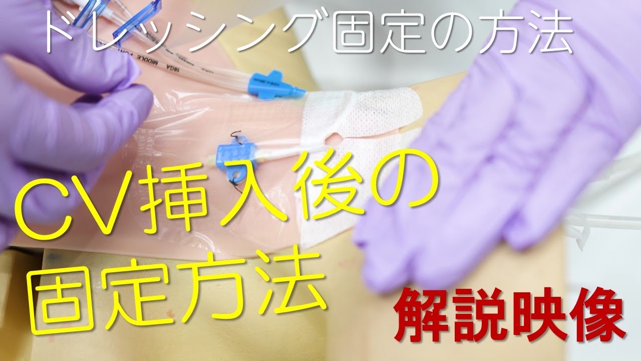 CV挿入後の固定方法について － 解説映像｜提供：東京北医療センター