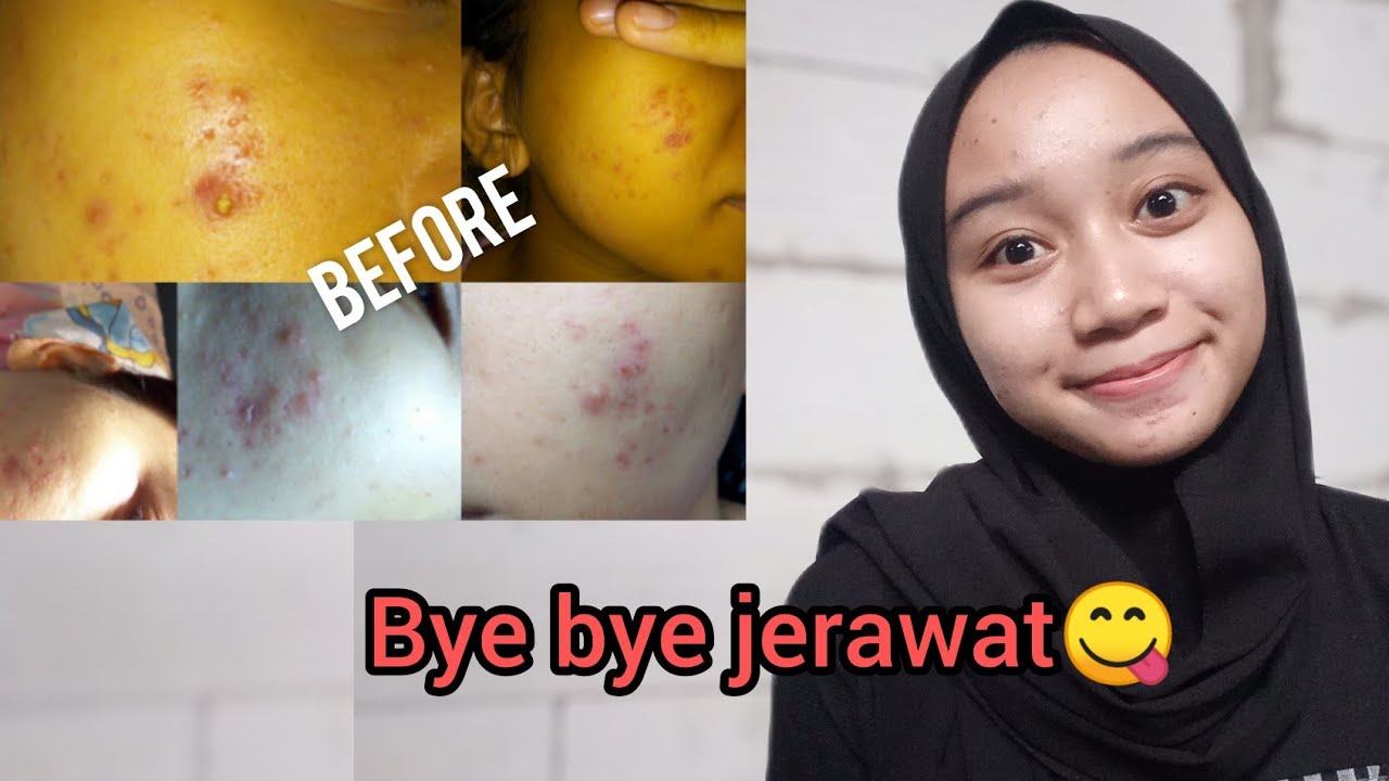 Cara menghilangkan jerawat 