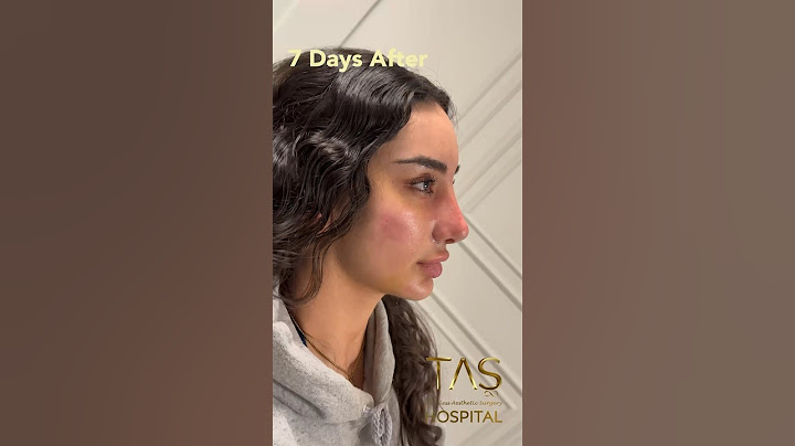 Scarless Facelift and Revision Rhinoplasty by Dr.TAS