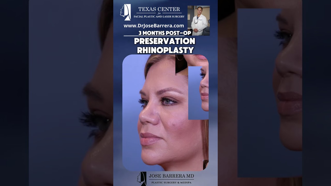 3 Months Post-Op Transformation! 