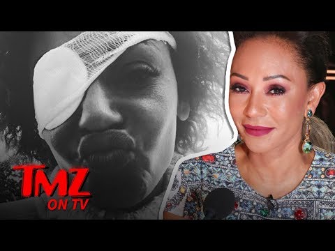 Mel B Sets Story Straight About Eye Problems | TMZ TV