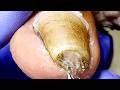 Wow, Long And Curly Toenails, Gentle Pedicure【Xue Yidao】