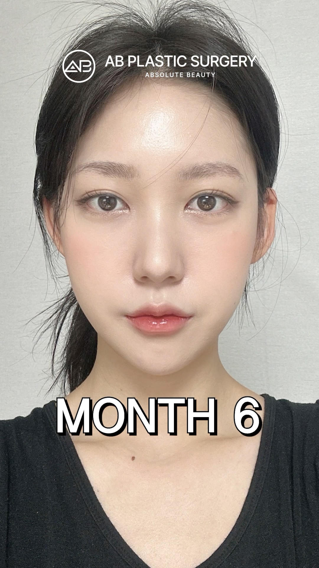 Korean Facial Contouring Fixed Everything #koreanplasticsurgery