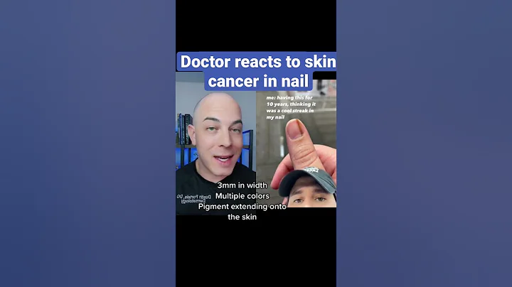 Doctor reacts to skin cancer in nail!