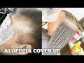 (#22) MAJOR ALOPECIA COVERAGE ON FRONT HAIR LINE✔