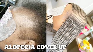 (#22) MAJOR ALOPECIA COVERAGE ON FRONT HAIR LINEโ (#22) MAJOR ALOPECIA COVERAGE ON FRONT HAIR LINEโ