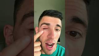 MY EYEBALL INJURY 😳