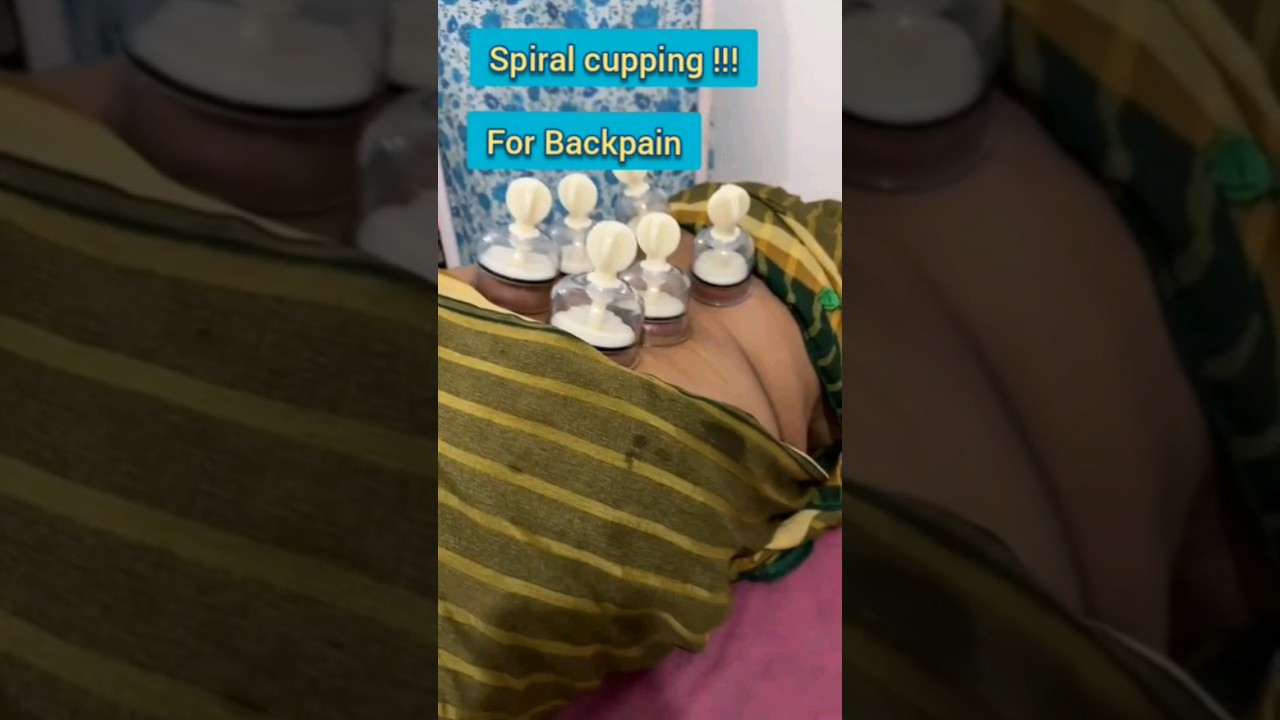#cupping