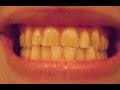 Bruxism and Teeth Grinding Treatment Bruxism and Teeth Grinding Treatment