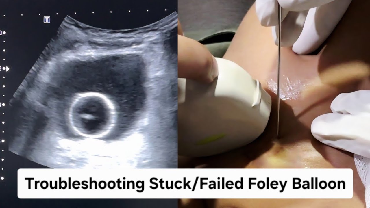 How to Troubleshoot Stuck/Failed Foley Balloon in Urinary Bladder - Dr ...
