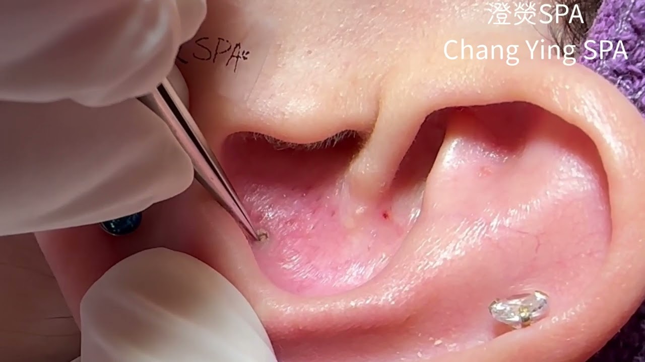 日常耳朵黑頭清潔影片 A new case of blackhead cleaning