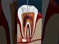 A root canal is a dental procedure used to save a badly decayed or infected tooth