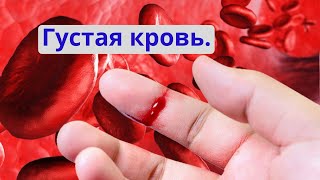 Есть ли СГУЩЕНИЕ КРОВИ, как это узнать?  Разжижение крови народными средствами без лекарств.