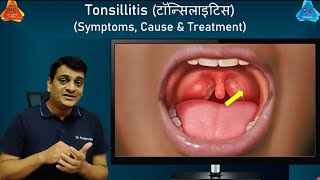 Tonsillitis  Home Remedies & Treatment | Symptoms & Causes of Tonsillitis (By Dr. Puspendra)