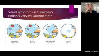 Glaucoma and Dry Eyes