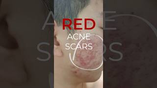 Treating ➡️ Red Acne Scars