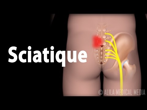 Sciatique, Animation.