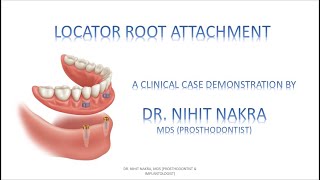 LOCATOR Root Attachment News