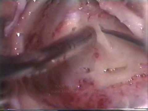 Labyrinthectomy for Meniere's disease