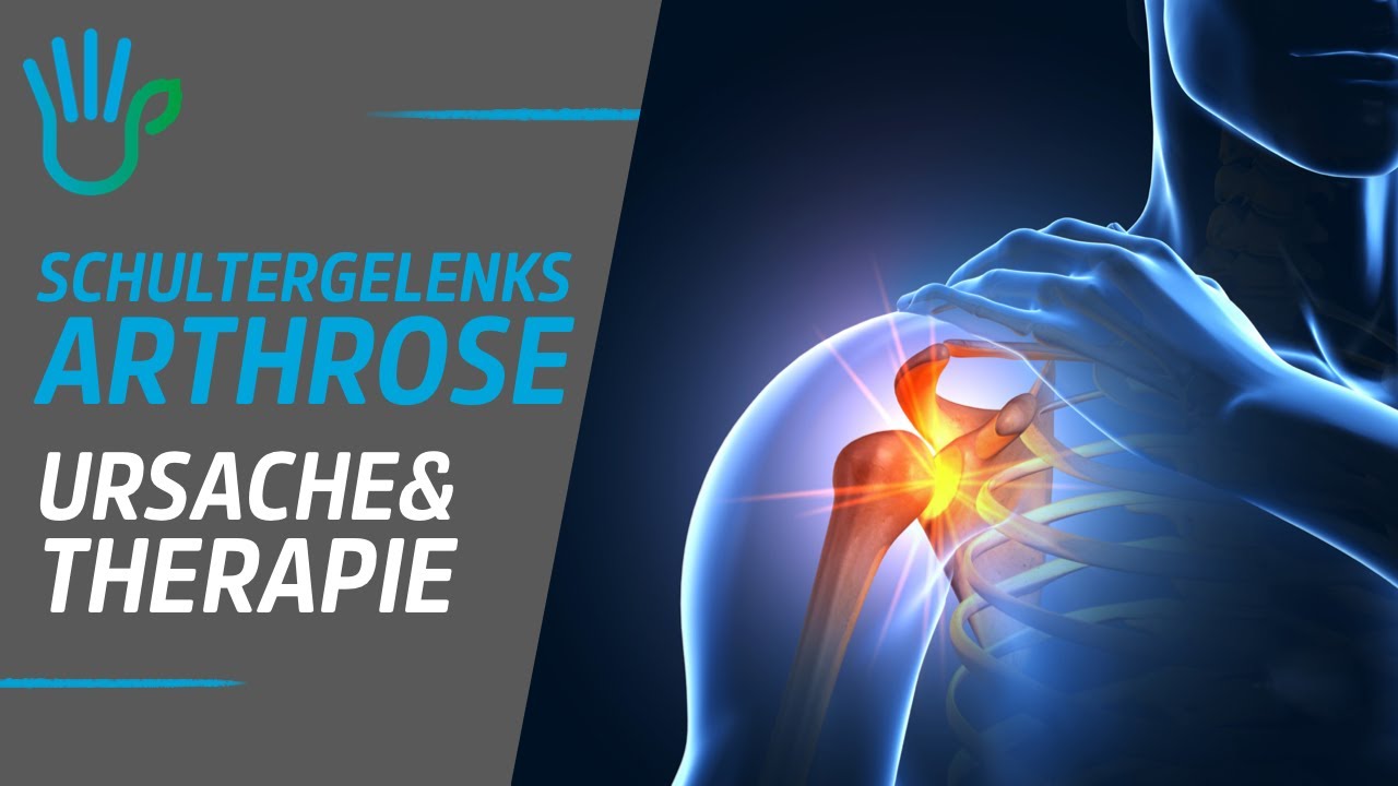 Schultergelenksarthrose, Frozen shoulder, Kalkschulter