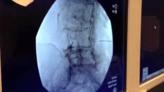 Bilateral Transforaminal Epidural Steroid Injection -  Offered in Las Vegas, Nevada