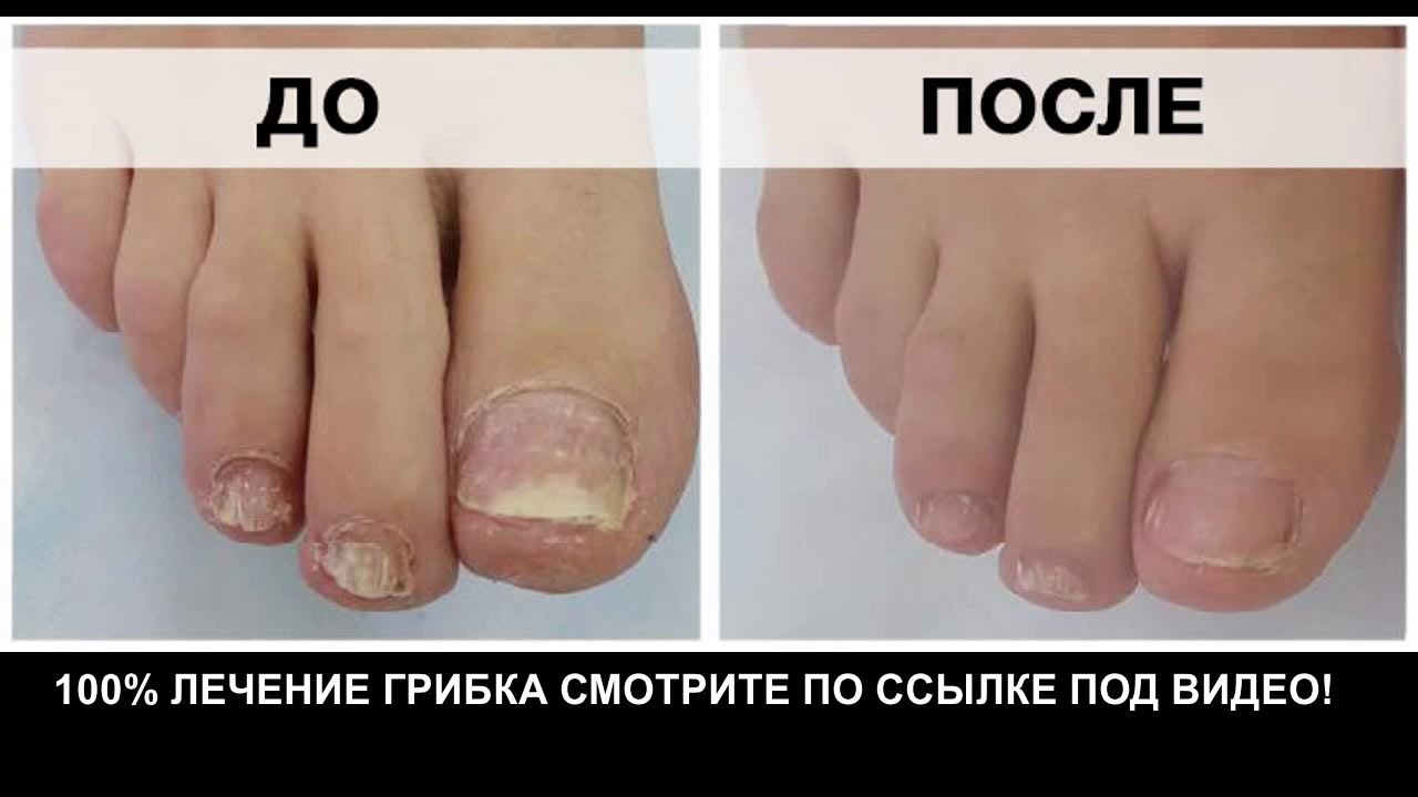 грибок ногтей анализ - YouTube