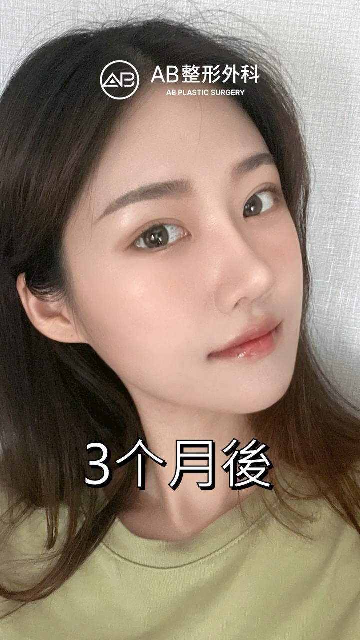 手術後，整個人變得更有女人味 #shorts