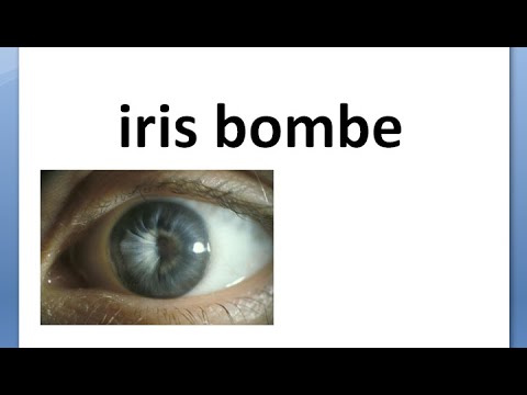 Video: Iris Bombe Trong Dogs - Vấn đề Về Mắt - Hoàn Thành Posterior Synechiae