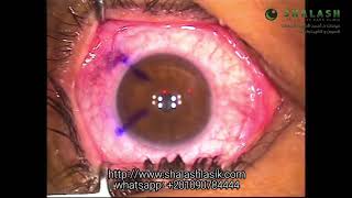 SBK LASIK (Ultra LASIK) عملية الالترا ليزك لايف - عيادات د أحمد شلش لطب و جراحات العيون