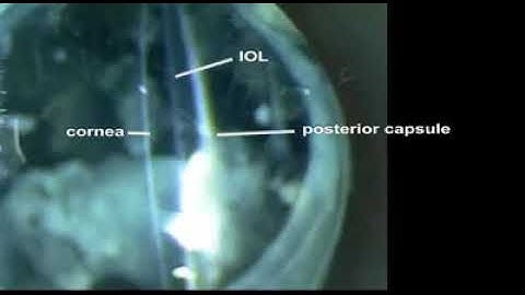 Case Root - Capsular Block Syndrome