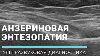 АНЗЕРИНОВАЯ ЭНТЕЗОПАТИЯ НА УЗИ 🦵 ⠀Pes anserinus ENTHESOPATHY on ultrasound ▶️