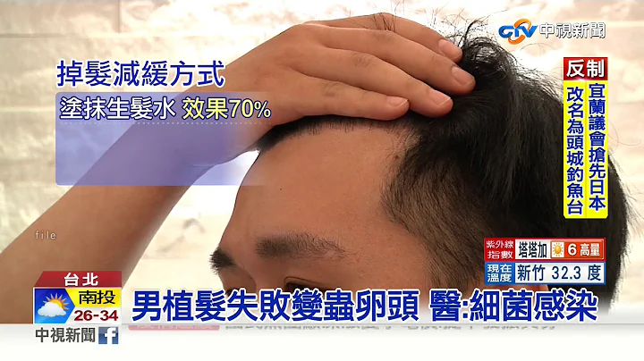 英國男植髮失敗 額頭布滿恐怖顆粒│中視新聞 20200617 - 天天要聞