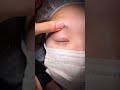 【二重整形/目頭切開】他院修正もお任せください!#shorts