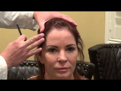 woman-receding-hairline-bald-hair-loss-transplant-surgery-1-yr-result-dr.-diep-www.mhtaclinic.com