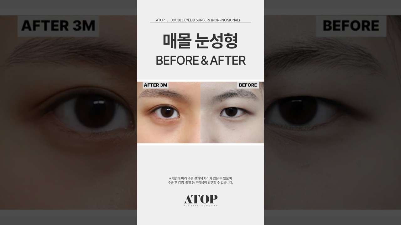 [Thẩm mỹ viện A-TOP] Cắt mí không phẫu thuật, sự khác biệt trước và sau là thật ư?! #catmi #phauthuatmat #thammyviengangnam