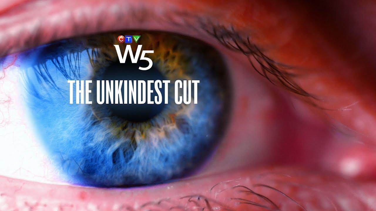 W5: Rare but devastating side effect of laser eye surgery