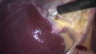 Доброкачественная опухоль желчного пузыря. Tumor of the gallbladder. Laparoscopic Cholecystectomy.